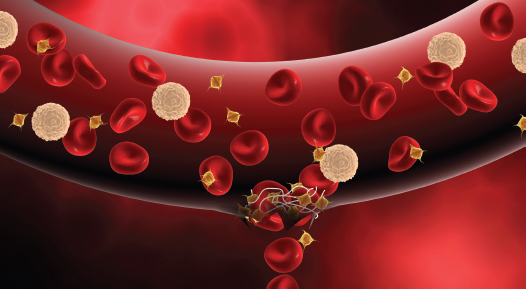 injury in blood vessel with overlying fibrin net, capturing platelets and red blood cells