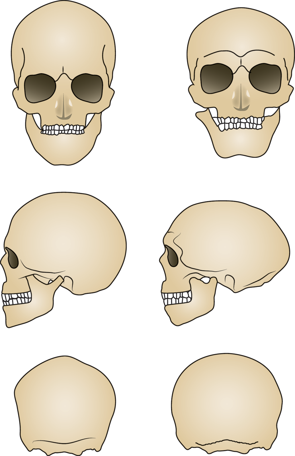 left: prominent frontal bone, skull is more round; right: depressed frontal bone, skull is more oblong