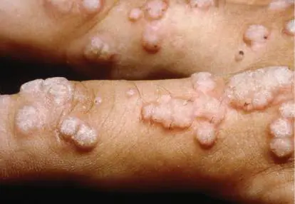 Figure from Chapter 26, Microbiology: An Evolving Science 6e